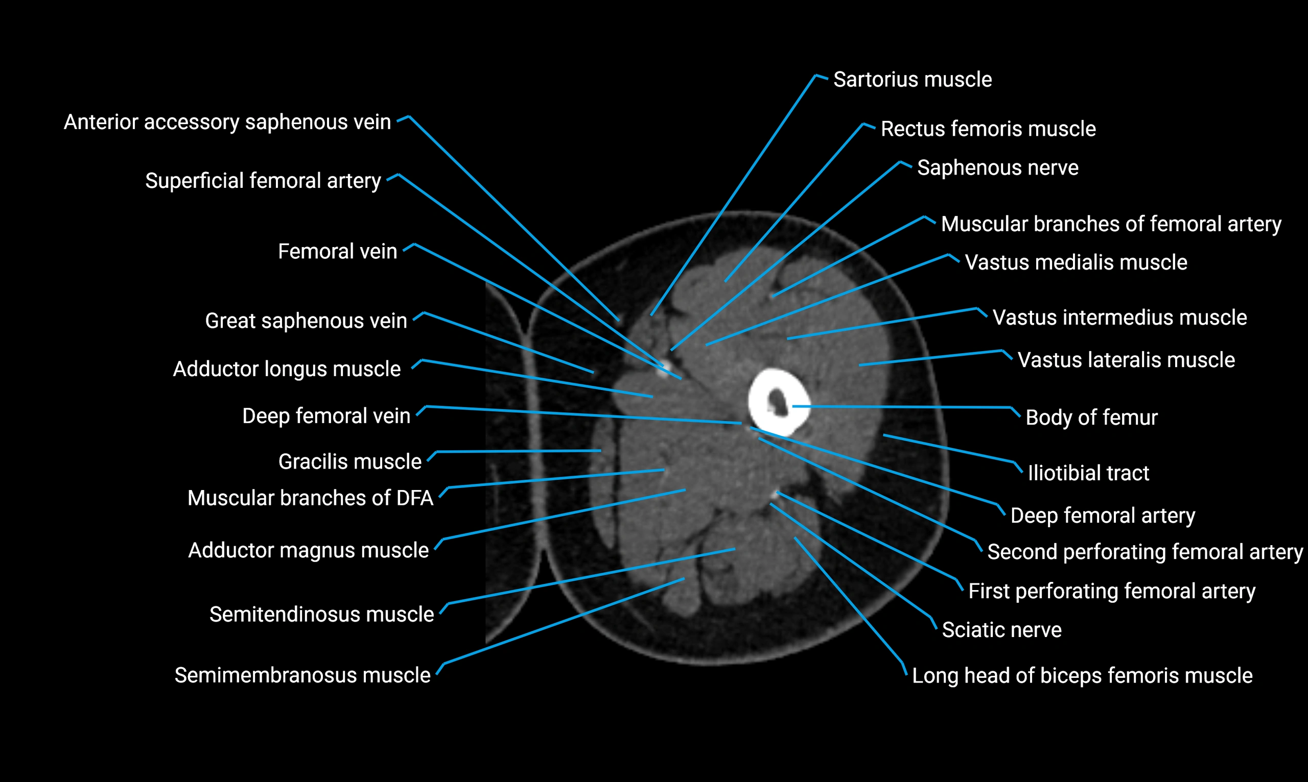 CT lower limb axial cross sectional anatomy labelled image 39 (2).webp